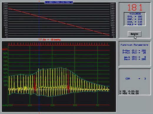 arterial elasticity made visible with software attached to HDO blood pressure monitor