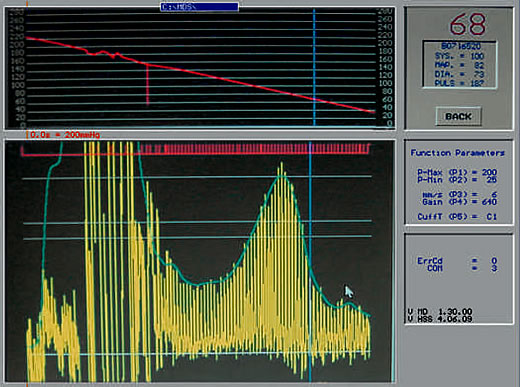 artifacts in blood pressure measurement becoming visible with bpm software