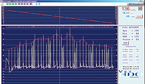 blood pressure curve of dog having sinus node block