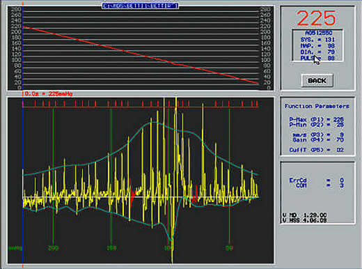 dysrhythmia made visible with software attached to HDO blood pressure monitor