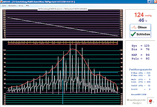 blood pressure curve of dog with sinus node block